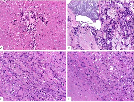 Figure 6. Pattern of elastic fiber damage in lymphoplasmacytic thoracic aortitis. A: A focus of plasma cells associated with elastic fiber loss within the media
