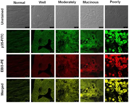 Figure 1. Detection of IL-35 expression in colorectal cancer tissues by immunostaining of EBI3 and p35