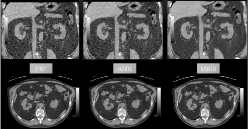Fig. 6 Large left kidney stone (circled). Side-by-side comparisons of coronal (top) and axial (bottom) images among three reconstruction algorithms
