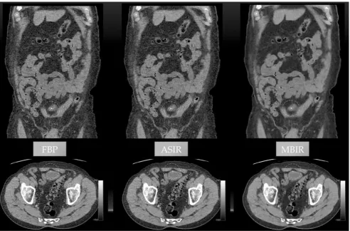 Fig. 8 Right vesico-ureteric stone (circled). Side-by-side comparisons of coronal (top) and axial (bottom) images among three reconstruction algorithms