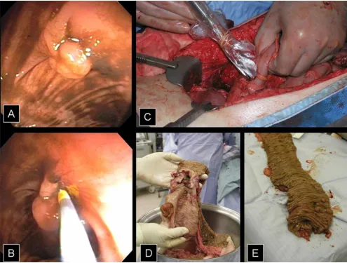Figure 3A and B) Sigmoid colon polyp and endoscopic injection of the baseA and B) Sigmoid colon polyp and endoscopic injection of the base