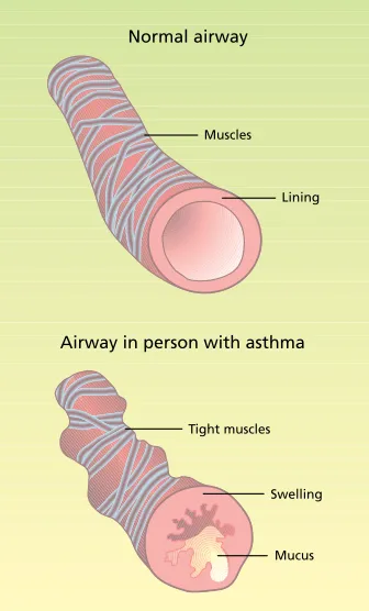 Fig. 1. Asthma pathology. Source: NhLBI 2006.