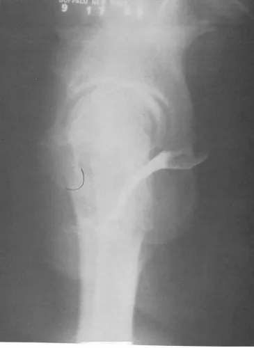 Fig 2-A normal vaginal depth and axis. The vaginal walls of a 25-year-old, healthy nulligravida have been painted with bar­ium