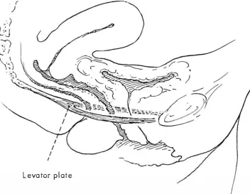 Fig 4-0rawing of normal vaginal axis of the l,v,ng showing almost horizontal upper vagina and rectum lying on and parallel to the levator plate