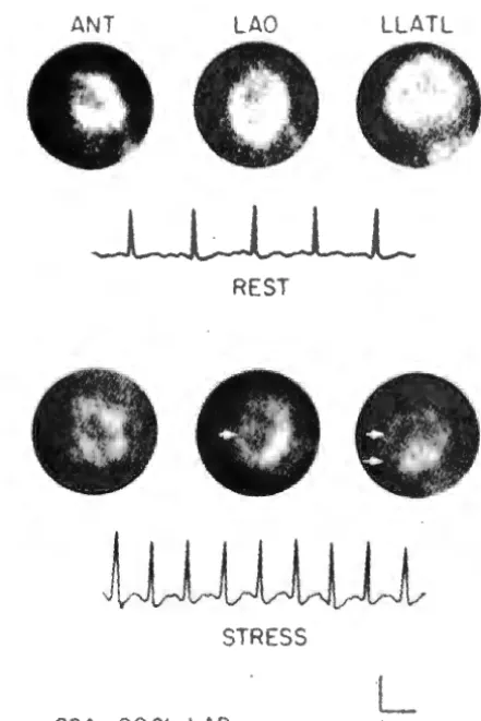 TABLE 2 Exercise Thallium Imaging 