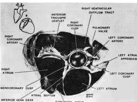 Fig 5-Still tricular septum, tole. frame of sector scan of short axis tomographic section of left ventricle at the level of mitral valve