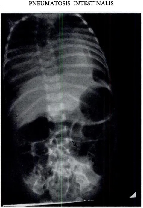 FIG. -1. Case2.â€”Microscopicappearanceof colon.Ringsof pink-stainingmaterialwithincysts are barelyvisible.