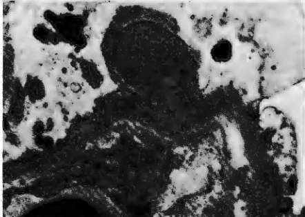 Figure 1 is gial coarse, capillary loops are occluded by proliferating mesan-the characteristic picture m unofluorescent staining for proteinuria