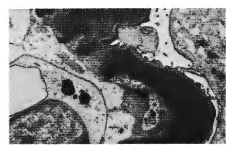 Fig I I-Electron tron-dense deposliferative glomerulonephritis type II. micrograph from a patient with membranopro-Note the homogeneous elec-it throughout the basement membrane