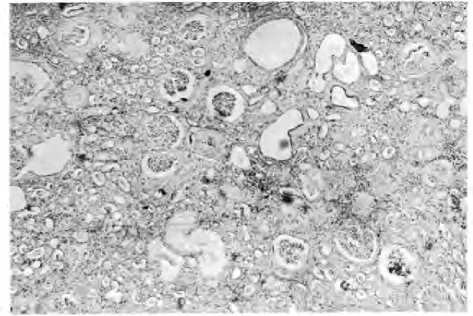Fig 3-Light reaction microscopic autopsy section (H & E stain) from a patient with chronic pyelonephritis