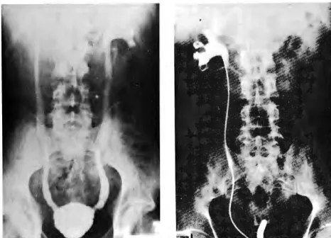 Fig 4-Voiding contrast system and cystourethrogram in a patient with acute cystitis bilateral reflux