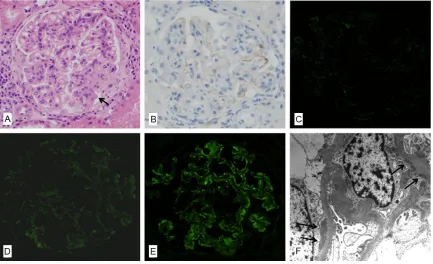 Figure 1. A representative renal biopsy specimen showing activation of the lectin pathway in lupus nephritis (case No