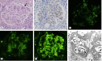 Figure 2. A representative renal biopsy specimen showing activation of the classical pathway in lupus nephritis (case No