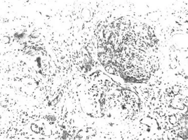 Fig 9-lmmunofluorescent preparation (lgG) from a portion of a biopsy of a patient with anti basement membrane antibody disease