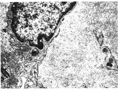 Fig 12-Electron microscopic preparation of a portion of a glome· rulus showing amyloid fibrils (X 24.000)