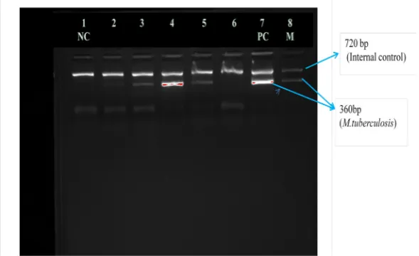 Figure 3A.  Lanes-4 was positive control (IS6110 gene targeted In-house PCR for detection of Mycobacteriumtuberculosis