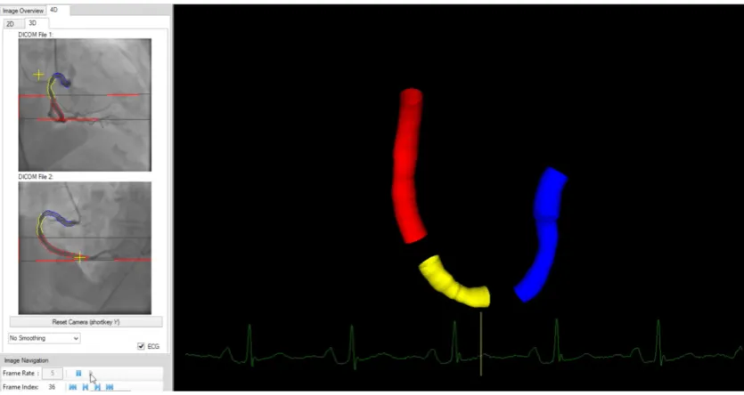Figure 1.  A three-dimensional model created with CAAS QCA4D prototype software (Pie Medical Imaging, the Netherlands) 