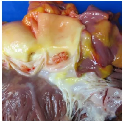 Figure  4.  Showing gross and histopathology of aortic valve 