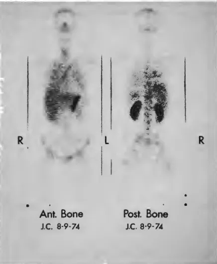 Fig. 4-Tc••m-Polyphosphate® (New England Nuclear) bone im-age demonstrating stomach uptake of free Tc••m·pertechnetate