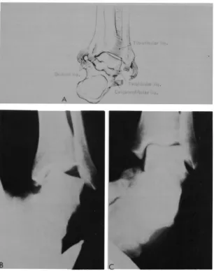 Fig 12-A. Diagrammatic illustration of the deranged ligaments of the la1eral ankle joint; 8 stress