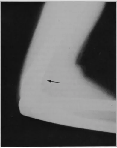 Fig 3-Complcte dislocation or the acromioclavicular joint. 