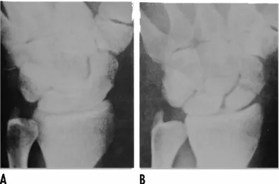 Fig 6-X-ray of wrist. B O'Donoghue. A. Initial x-ray thought to be negative. B. X-ray 14 days later showing a fracture of the carpal navicular