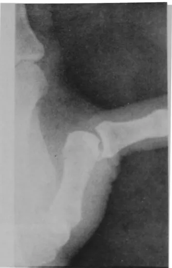 Fig 7-Posili\'c stress x-ra) �hO\\ing rupture of the ul11�1r i..:oll..lh.:ral ligament or the thumb