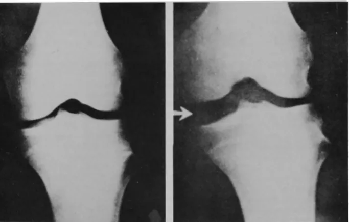 Fig 10-The slocum test for rotary instability (see text). 