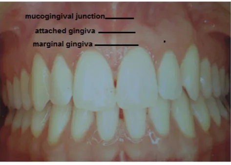 Figure 5.  Keratinized gingiva  