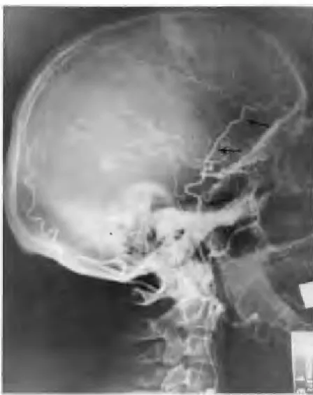 Fig. !-Preoperative internal carotid artery, collateral circulation through oph-thalmic angiogram demonstrates occlusion of artery, and the course of the superficial temporal artery (arrows)