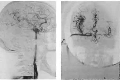 Fig. SA, B-Postoperative angiograms of a patient who had generalized low perfusion due to occlusion of all major cere-bral vessels