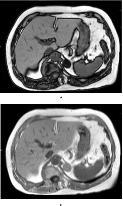 Figure 1.  Standard abdominal MRI protocol including sequences with high sensitivity for free and bound water, microscopic and macroscopic fat, paramagnetic substances, fibrosis, and solid tissue