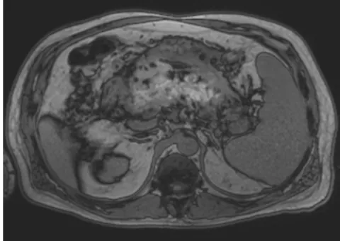 Figure 7.  Fat saturated pre-gadolinium T1 weighted 3D gradient echo hemorrhagic renal cysts containing subacute blood products.sequence showing bilateral T1 hyperintense renal lesions, representing  