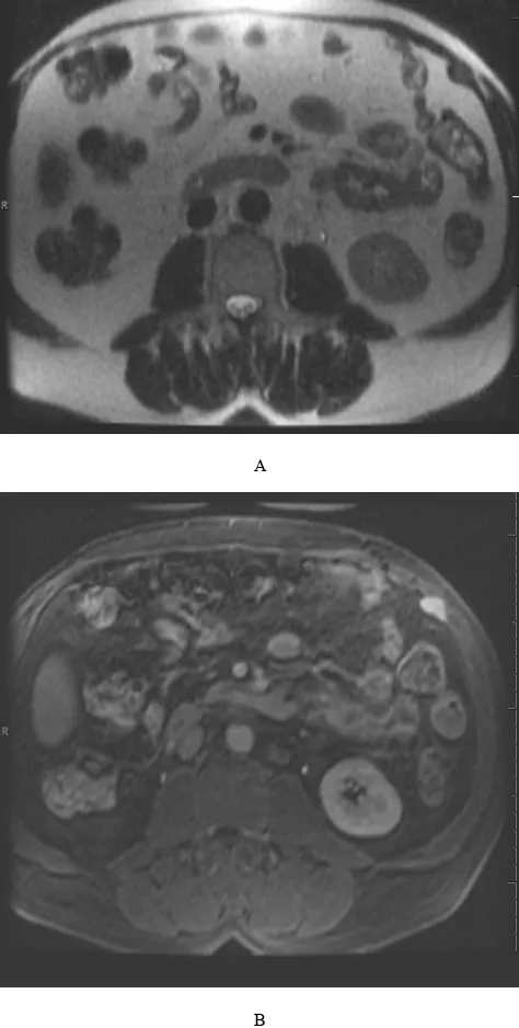 Figure 11.  Axial T2 (A) and axial fat saturated post-gadolinium (B) sequences demonstrate a T2 hypointense, enhancing left ventral abdominal wall desmoid tumor