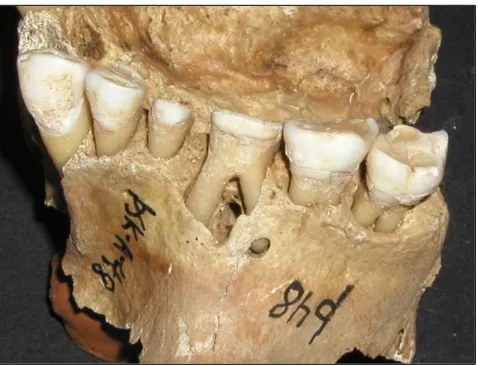 Figure 4.  Root abscess in tooth 16 due to tooth wear. 