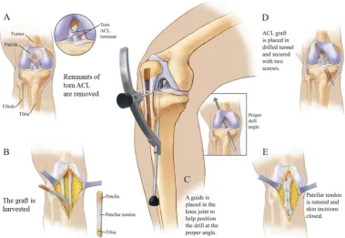Figure 1.2 Schematics of ACL reconstructiona patella tendon with bone plugs at distal ends