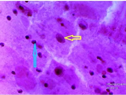 Figure 5.  The same case of Hashimoto thyroiditis, cell-block. The lymphocytic infiltrates appear as a lymphoid follicle, and plasma cell could be seen 'the land mark for Hashimoto`s thyroiditis' (the red arrow)