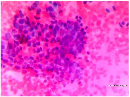 Figure 11.  Histopathological picture of the previous case, showing follicular variant of papillary carcinoma