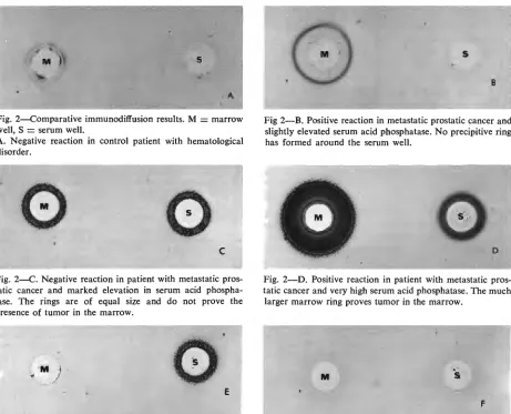 Fig 2-B. Positive reaction in metastatic prostatic cancer and slightly elevated serum acid phosphatase