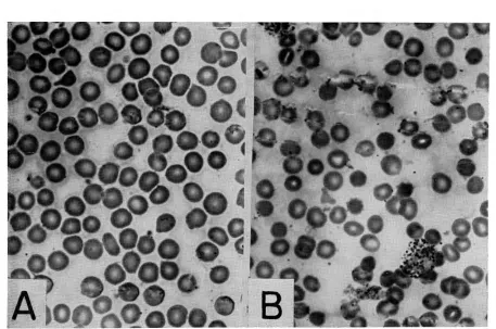 Fig 2-Photomicrographs of rabbit's blood smear (Wright Stain). (A) Normal rabbit. (B) Same animal 2 hr after in-travenous administration of pneumococcal hemolysin