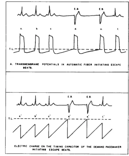 Fig 2-Actual workings of the ventricular demand or in-hibited pacemaker 