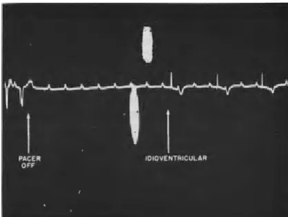 Fig !--Sudden discontinuance of rapid pacing achieves a prolonged asystole and quiet heart