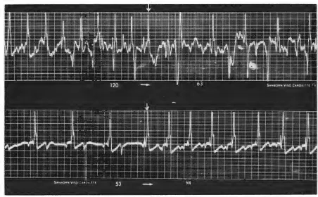 Fig 2-A tracing obtained by telemetry which reveals one of the problems with P-wave pacing
