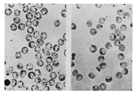 Fig. 2- Heinz body formation after incubation with acetylphenylhydrazine. Primaquine-sensitive red cells of cells on the left, normal red on the right