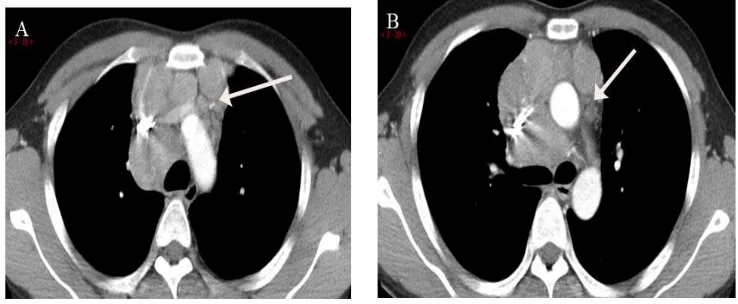 Figure 3-A 34-year-old male with thymoma (Contrast CT) shows heterogeneous mild enhancement anterior mediastinum mass with  3A- Compression of superior venacava, brachiocephalic trunk, subclavian artery, common 