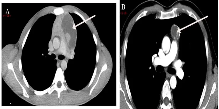 Figure 5A- An 18-year-old male with lymphoma shows heterogeneous anterior mediastinal mass with huge inner cyst (arrow)