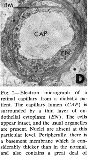 Fig. 1-Electron micrograph of a retinal capillary from a non-diabetic human patient for comparison with Figure 2