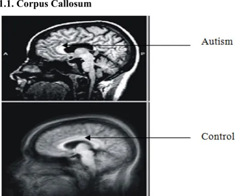 Figure 1.  Corpus callosum of brain for control and autistic. 