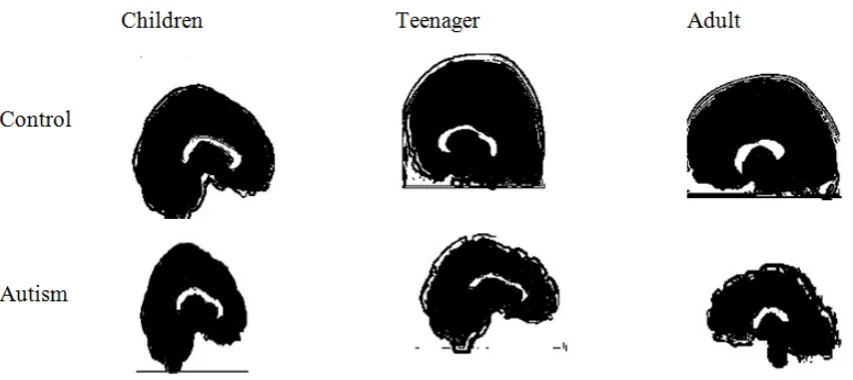Figure 8.  Processed images of the corpus callosum using Sobel operator of control and autistic for children, teenager and adult