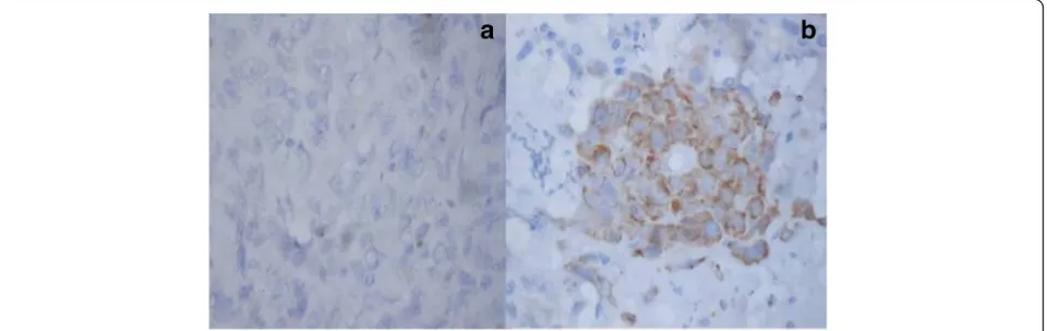 Fig. 3 Immunohistochemistry for EGFR: a weak positive staining and b strong positive staining in oral squamous cell carcinoma